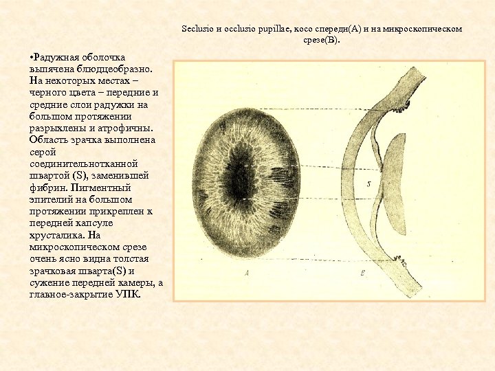 Seclusio и occlusio pupillae, косо спереди(А) и на микроскопическом срезе(В). • Радужная оболочка выпячена