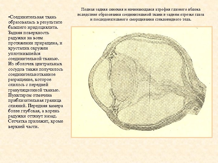  • Соединительная ткань образовалась в результате бывшего иридоциклита. Задняя поверхность радужки на всем