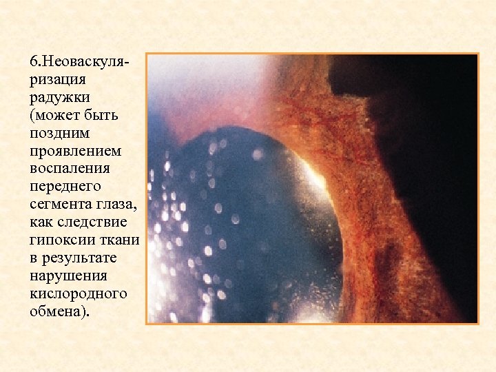 6. Неоваскуляризация радужки (может быть поздним проявлением воспаления переднего сегмента глаза, как следствие гипоксии
