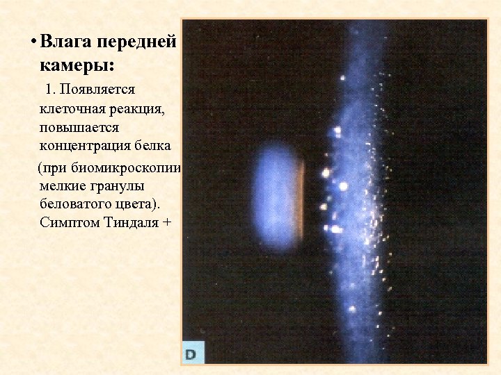  • Влага передней камеры: 1. Появляется клеточная реакция, повышается концентрация белка (при биомикроскопии