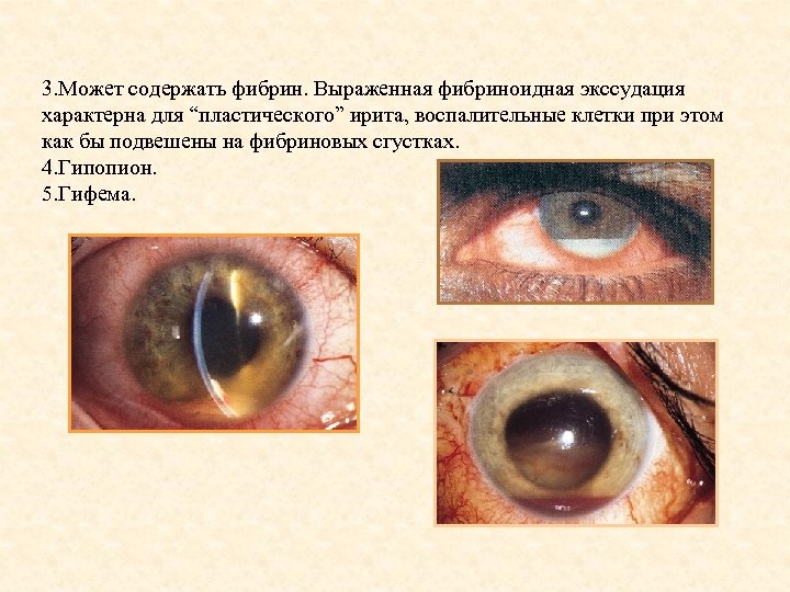 3. Может содержать фибрин. Выраженная фибриноидная экссудация характерна для “пластического” ирита, воспалительные клетки при