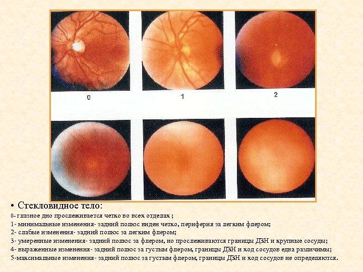  • Стекловидное тело: 0 - глазное дно прослеживается четко во всех отделах ;
