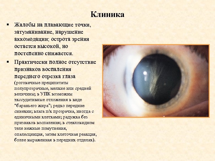 Клиника § Жалобы на плавающие точки, затуманивание, нарушение аккомодации; острота зрения остается высокой, но