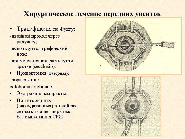 Хирургическое лечение передних увеитов • Трансфиксия по Фуксу: -двойной прокол через радужку; -используется грефовский