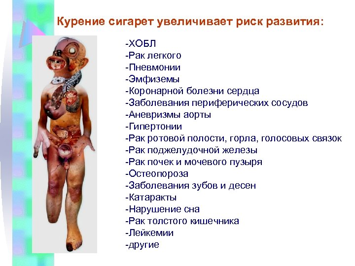 Курение сигарет увеличивает риск развития: -ХОБЛ -Рак легкого -Пневмонии -Эмфиземы -Коронарной болезни сердца -Заболевания