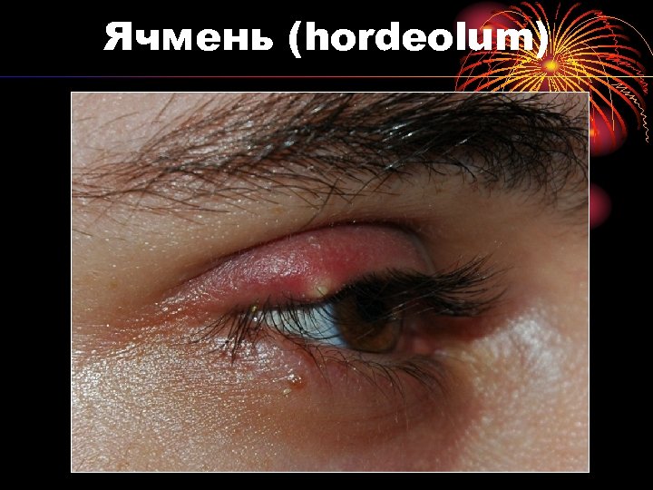 Ячмень (hordeolum) 