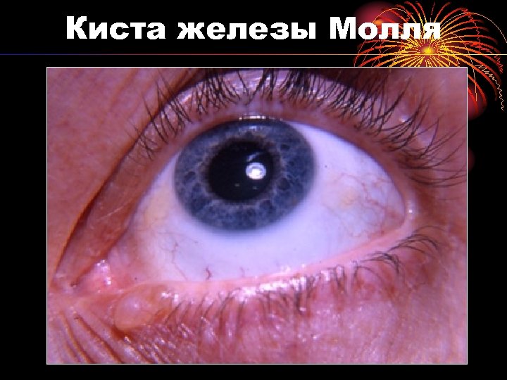 Киста железы Молля 