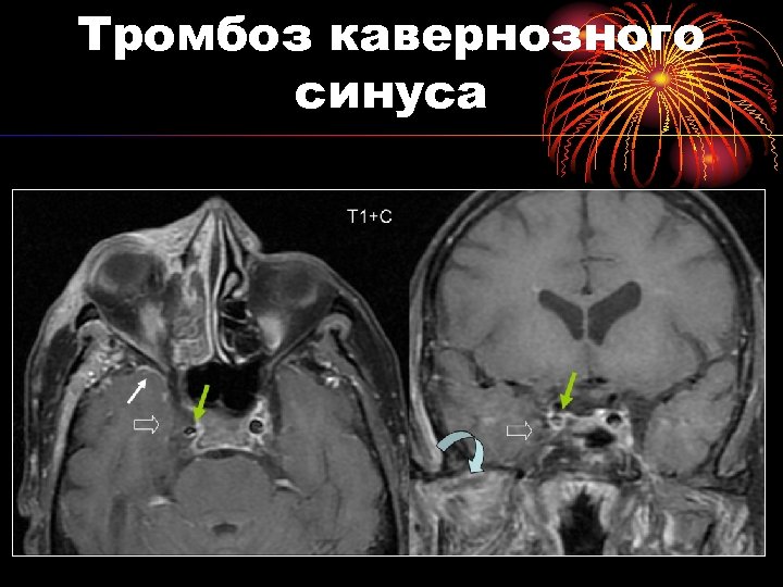 Тромбоз кавернозного синуса 