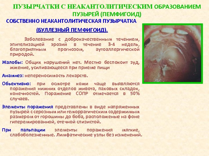 ПУЗЫРЧАТКИ С НЕАКАНТОЛИТИЧЕСКИМ ОБРАЗОВАНИЕМ ПУЗЫРЕЙ (ПЕМФИГОИД) СОБСТВЕННО НЕАКАНТОЛИТИЧЕСКАЯ ПУЗЫРЧАТКА (БУЛЛЕЗНЫЙ ПЕМФИГОИД). Заболевание с доброкачественным