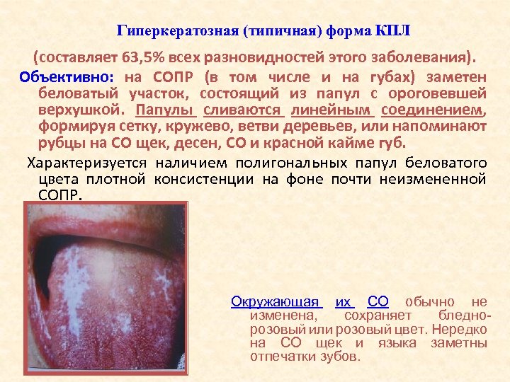 Гиперкератозная (типичная) форма КПЛ (составляет 63, 5% всех разновидностей этого заболевания). Объективно: на СОПР