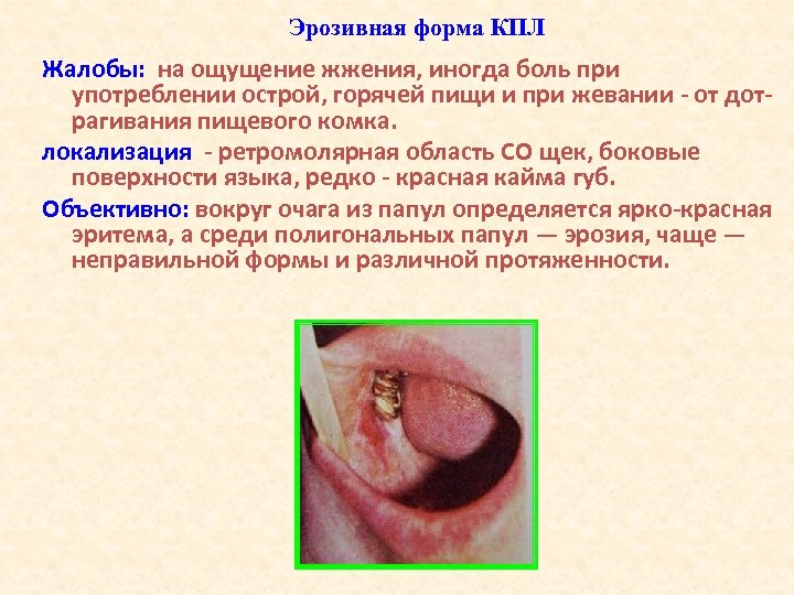 Эрозивная форма КПЛ Жалобы: на ощущение жжения, иногда боль при употреблении острой, горячей пищи