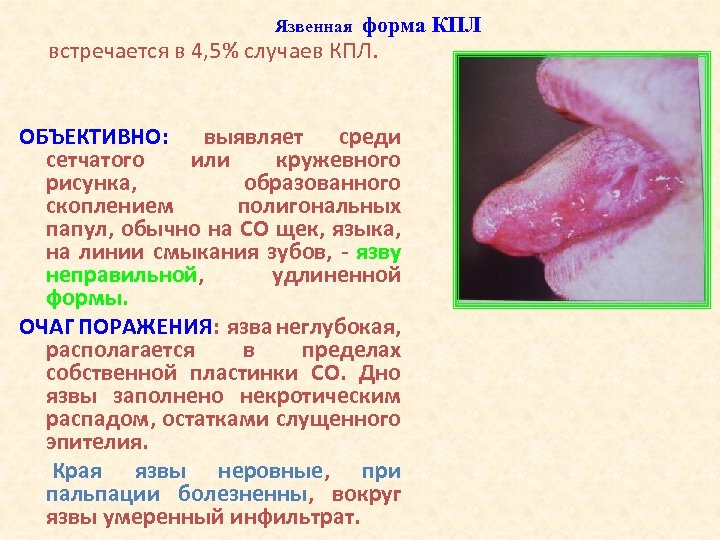 Язвенная форма КПЛ встречается в 4, 5% случаев КПЛ. ОБЪЕКТИВНО: выявляет среди сетчатого или
