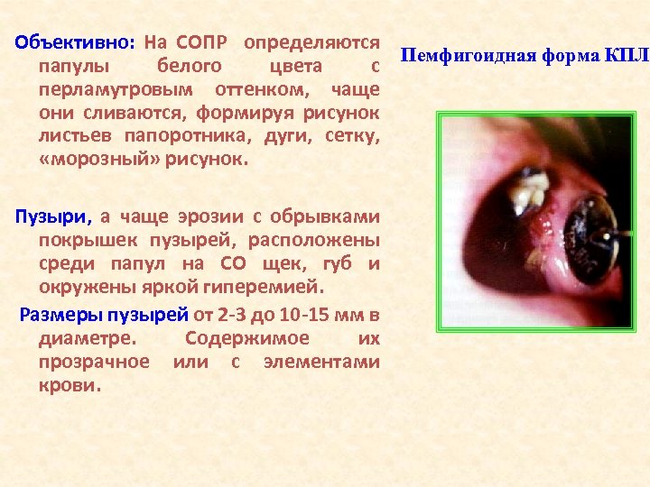 Объективно: На СОПР определяются папулы белого цвета с Пемфигоидная форма КПЛ перламутровым оттенком, чаще