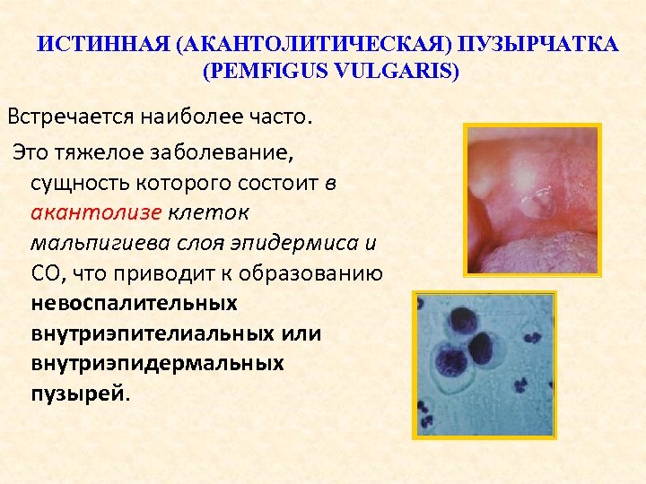 ИСТИННАЯ (АКАНТОЛИТИЧЕСКАЯ) ПУЗЫРЧАТКА (PEMFIGUS VULGARIS) Встречается наиболее часто. Это тяжелое заболевание, сущность которого состоит