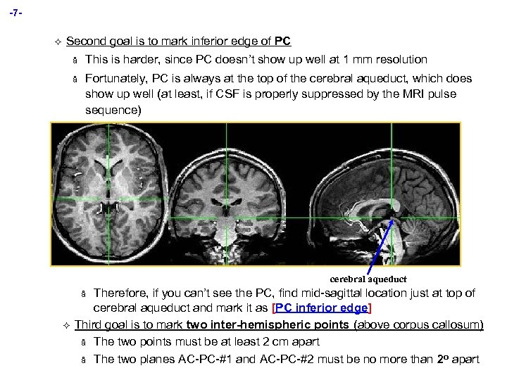 -7² Second goal is to mark inferior edge of PC å This is harder,