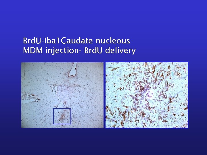 Brd. U-Iba 1 Caudate nucleous MDM injection- Brd. U delivery 