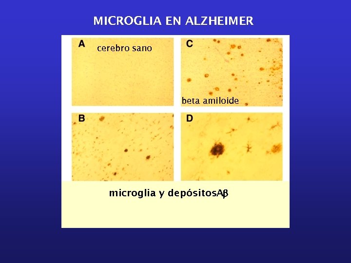 MICROGLIA EN ALZHEIMER cerebro sano beta amiloide microglia y depósitos. Ab 