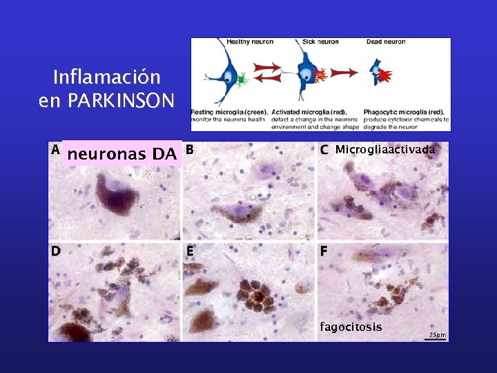 Inflamación en PARKINSON neuronas DA Microgliaactivada fagocitosis 