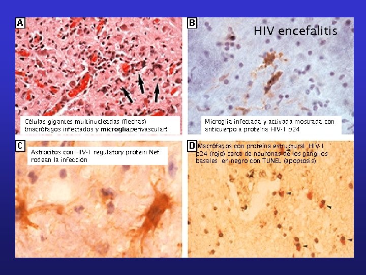 HIV encefalitis Células gigantes multinucleadas (flechas) (macrófagos infectados y microgliaperivascular) Astrocitos con HIV-1 regulatory