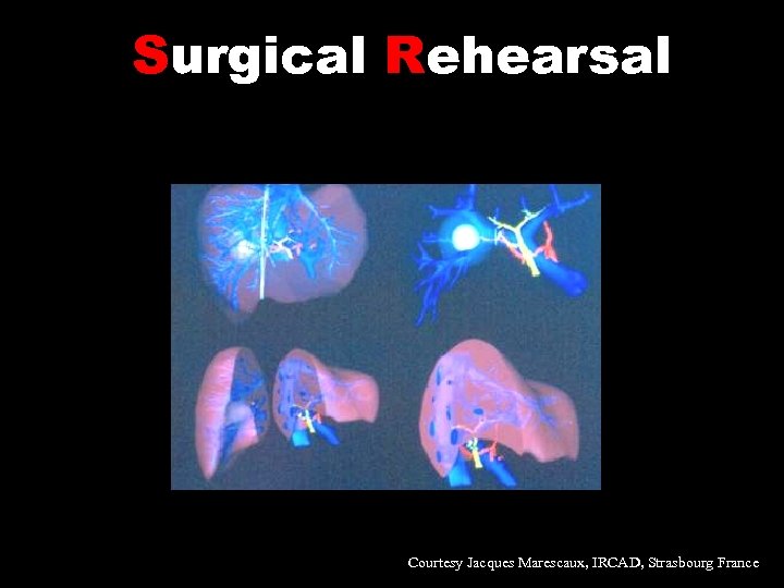 Surgical Rehearsal Courtesy Jacques Marescaux, IRCAD, Strasbourg France 