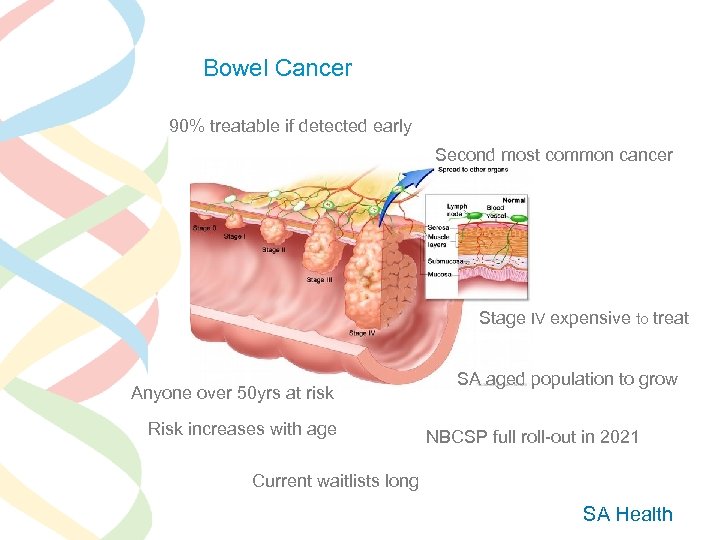 Bowel Cancer 90% treatable if detected early Second most common cancer Stage IV expensive