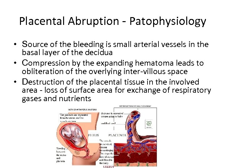 Placental Abruption - Patophysiology • Source of the bleeding is small arterial vessels in
