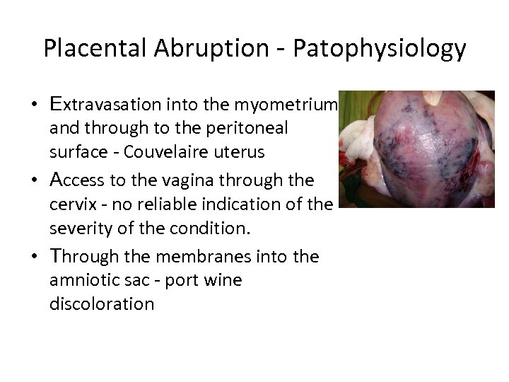 Placental Abruption - Patophysiology • Extravasation into the myometrium and through to the peritoneal
