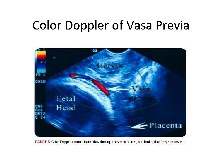 Color Doppler of Vasa Previa 