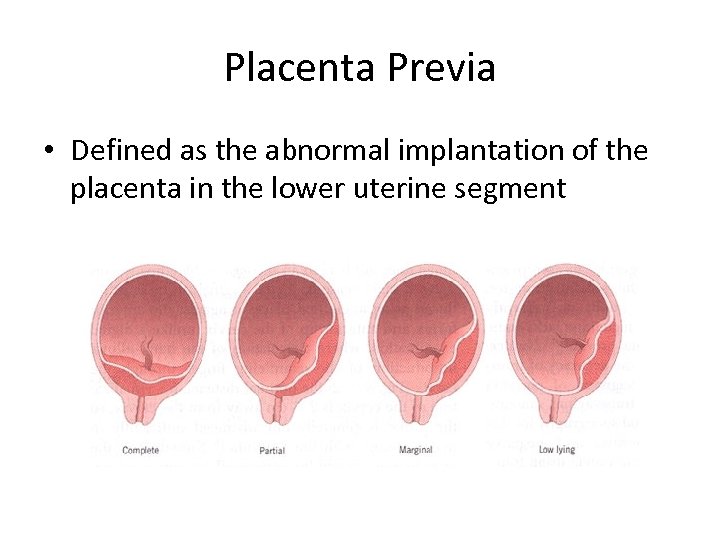 Placenta Previa • Defined as the abnormal implantation of the placenta in the lower