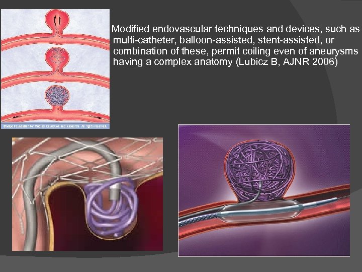 Modified endovascular techniques and devices, such as multi-catheter, balloon-assisted, stent-assisted, or combination of these,