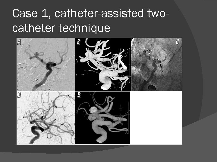Case 1, catheter-assisted twocatheter technique 