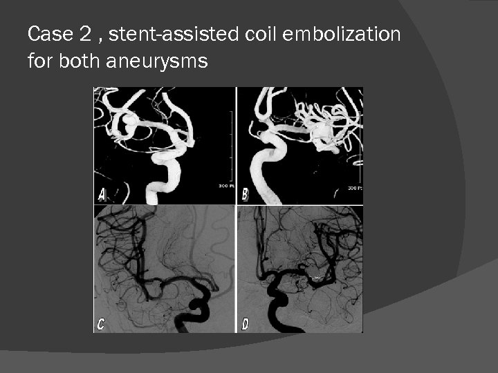 Case 2 , stent-assisted coil embolization for both aneurysms 