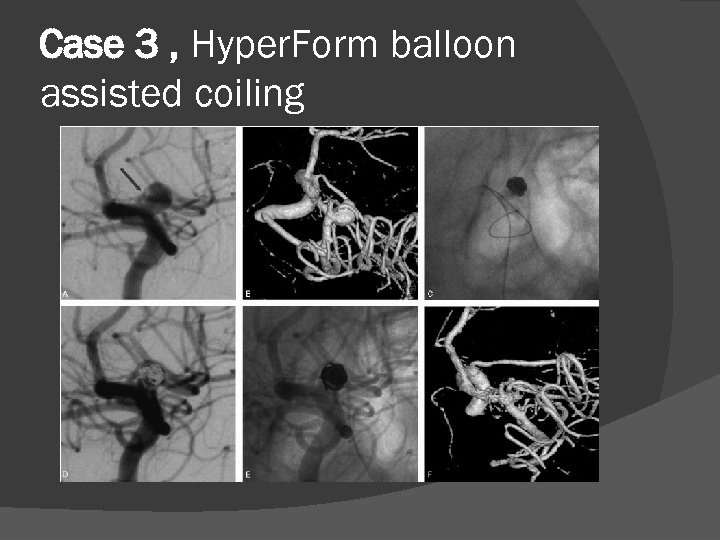 Case 3 , Hyper. Form balloon assisted coiling 