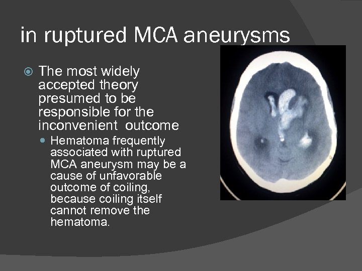in ruptured MCA aneurysms The most widely accepted theory presumed to be responsible for
