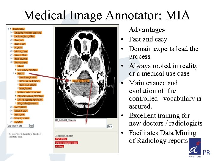 Medical Image Annotator: MIA • • • Advantages Fast and easy Domain experts lead