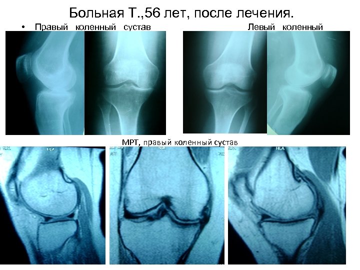 Больная Т. , 56 лет, после лечения. • Правый коленный сустав МРТ, правый коленный