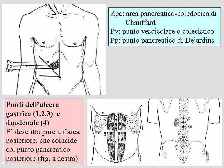 Zpc: area pancreatico-coledocica di Chauffard Pv: punto vescicolare o colecistico Pp: punto pancreatico di