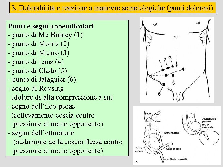 3. Dolorabilità e reazione a manovre semeiologiche (punti dolorosi) Punti e segni appendicolari -