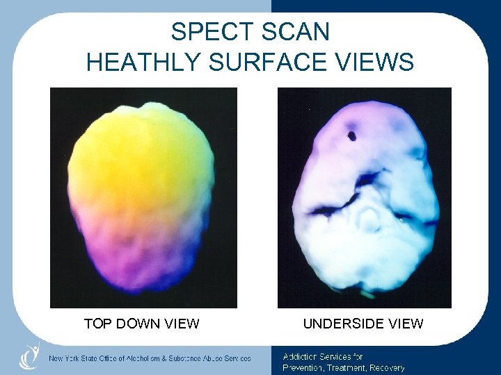 SPECT SCAN HEATHLY SURFACE VIEWS TOP DOWN VIEW UNDERSIDE VIEW 