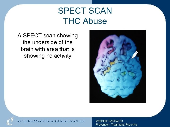 SPECT SCAN THC Abuse A SPECT scan showing the underside of the brain with