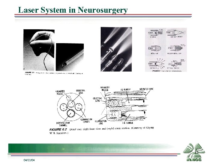 Laser System in Neurosurgery 33 04/22/04 