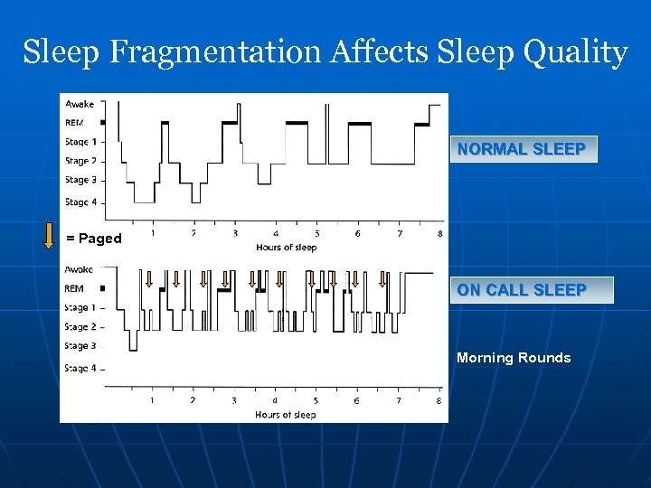 Sleep Fragmentation Affects Sleep Quality NORMAL SLEEP = Paged ON CALL SLEEP Morning Rounds
