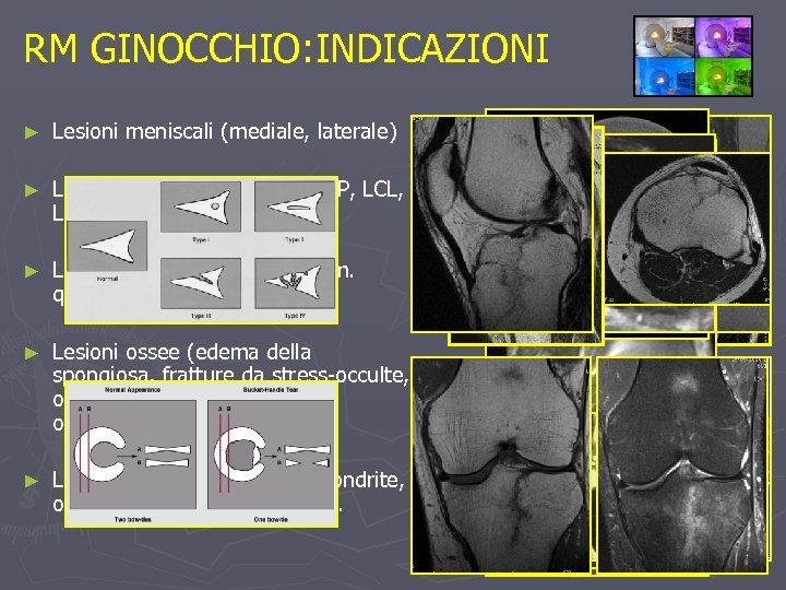 RM GINOCCHIO: INDICAZIONI ► Lesioni meniscali (mediale, laterale) ► Lesioni legamentose (LCA, LCP, LCL,