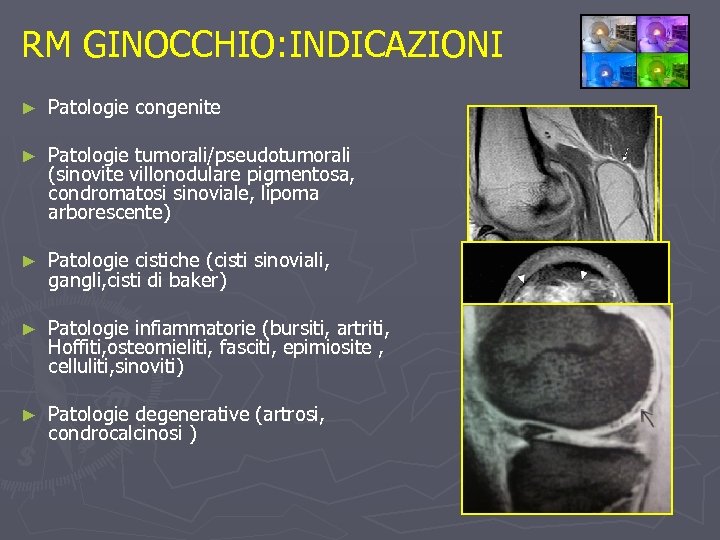 RM GINOCCHIO: INDICAZIONI ► Patologie congenite ► Patologie tumorali/pseudotumorali (sinovite villonodulare pigmentosa, condromatosi sinoviale,