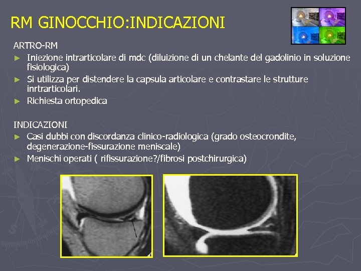 RM GINOCCHIO: INDICAZIONI ARTRO-RM ► Iniezione intrarticolare di mdc (diluizione di un chelante del