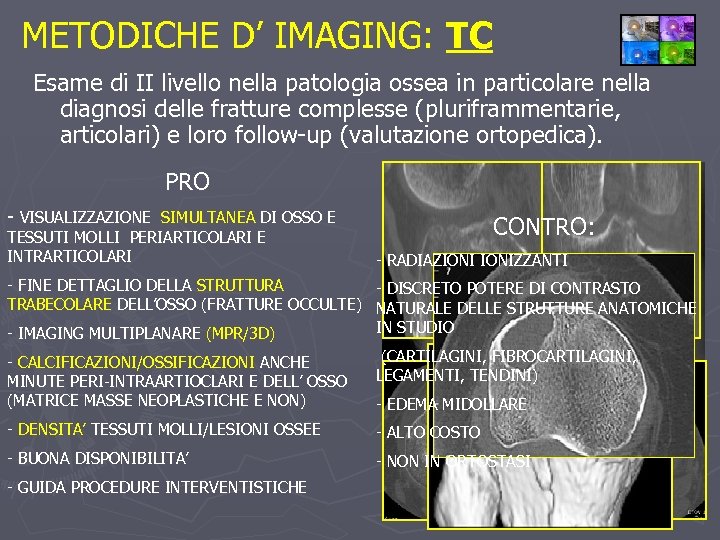 METODICHE D’ IMAGING: TC Esame di II livello nella patologia ossea in particolare nella