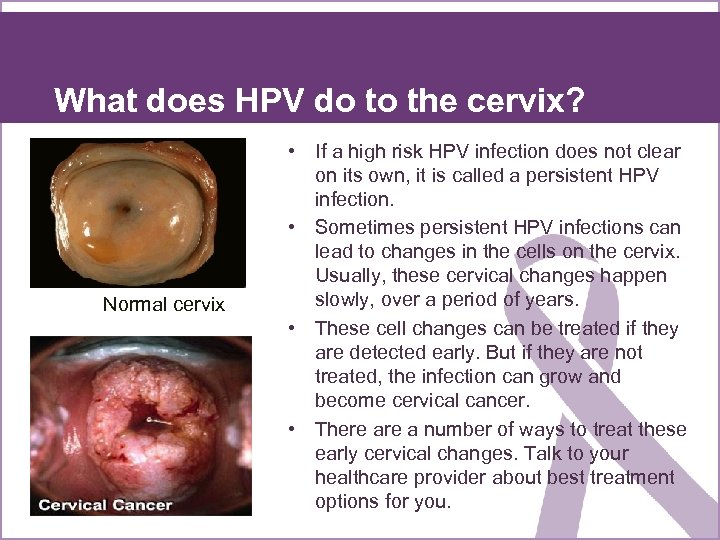 What does HPV do to the cervix? Normal cervix • If a high risk