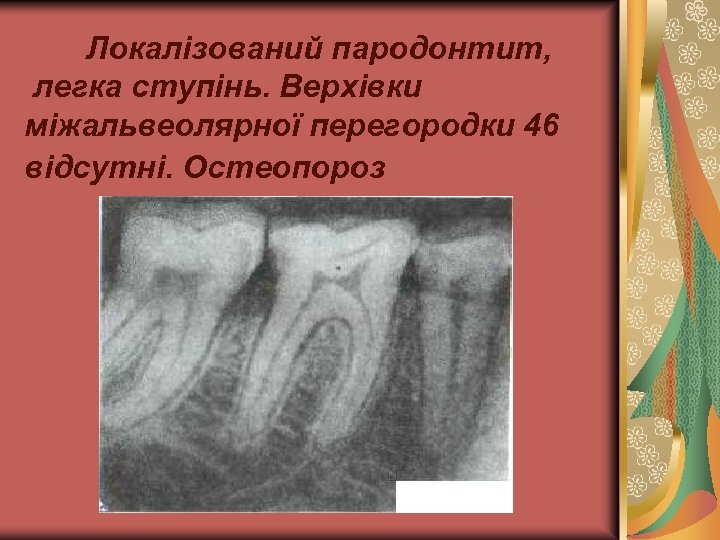 Локалізований пародонтит, легка ступінь. Верхівки міжальвеолярної перегородки 46 відсутні. Остеопороз 