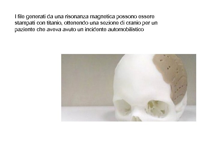 I file generati da una risonanza magnetica possono essere stampati con titanio, ottenendo una
