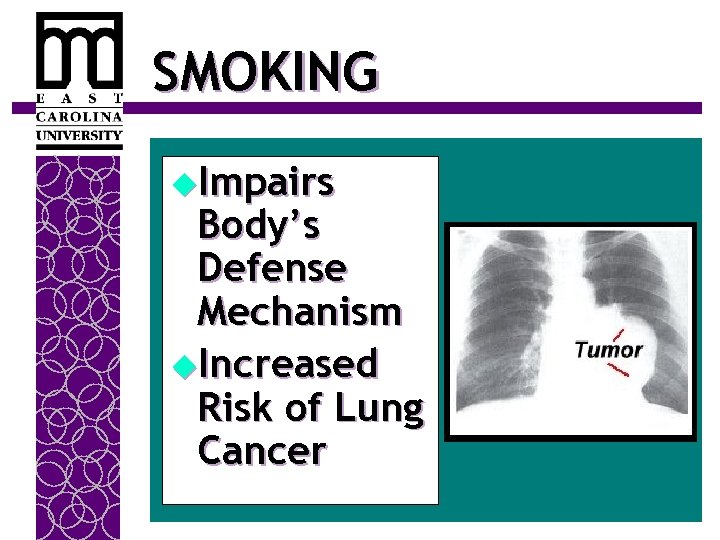 SMOKING u. Impairs Body’s Defense Mechanism u. Increased Risk of Lung Cancer 
